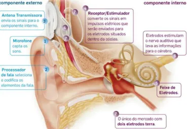 Figura 12 - Implante Coclear  (Politecsaude, s.d.) 