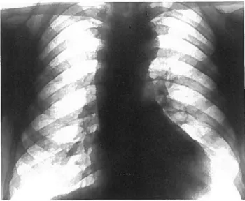 Figura 4: CoartacAo — erosOes costais; vascularizacao pulmonar normal.