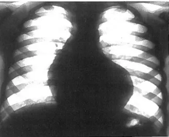 Figura 5: Tetralogia de Fallo — oligoemia; depressao do arco pulmonar, elevacao do apex.