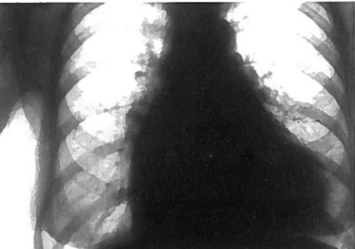 Figura 10: Doenca mitral (radiografia penetrada) — aumento de tamanho da A.E.