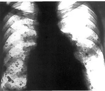Figura 12: Atrésia aôrtica em recém-nascido: edema pulmonar intersticial