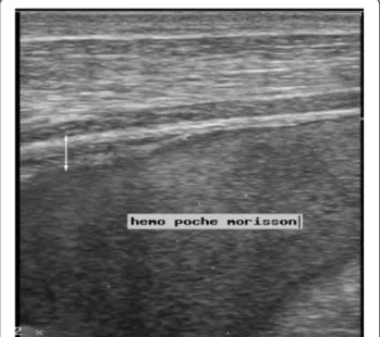 Fig. 5 Ultrasound image of a hemoperitoneum in the pouch of Morrison with echogenic appearance of parietal peritoneum thickening (double-headed arrow)