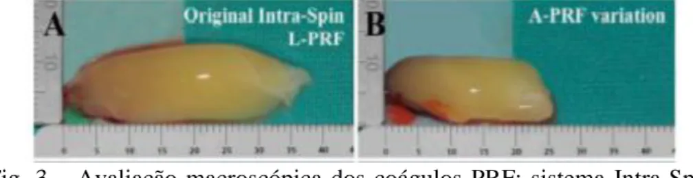 Fig.  3  – Avaliação  macroscópica  dos  coágulos  PRF:  sistema  Intra-Spin  L-PRF  (A), sistema A-PRF (B).(87) (Imagem usada sem permissão do autor) 