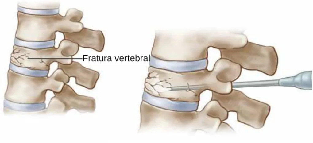 Fig. 3. Tratamento de uma fratura por compressão através do processo de vertebroplastia [110]