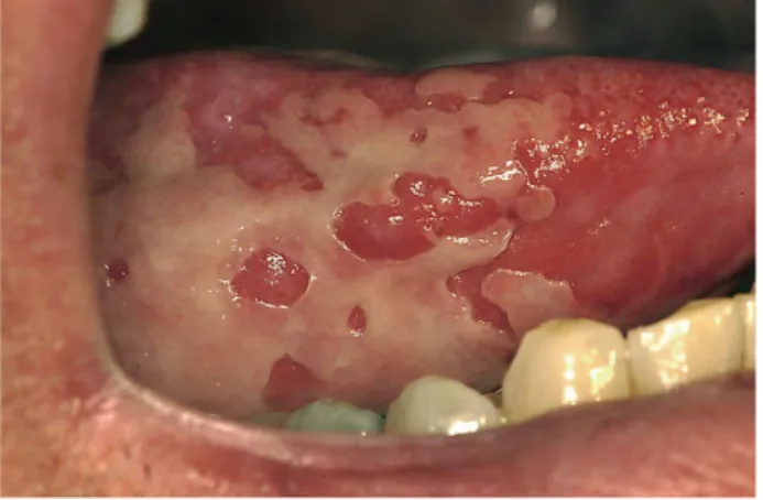 Fig. 1 - Ulceração da mucosa em paciente com mucosite de Grau 3. Fonte Sciubba et al 2006 (sem autorização  do autor) 