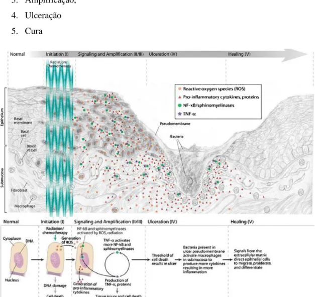 Fig. 2 - A patobiologia da Mucosite como um processo de 5 etapas. Fonte: Sonis  et al 2010 (adaptado sem a  autorização do autor) 