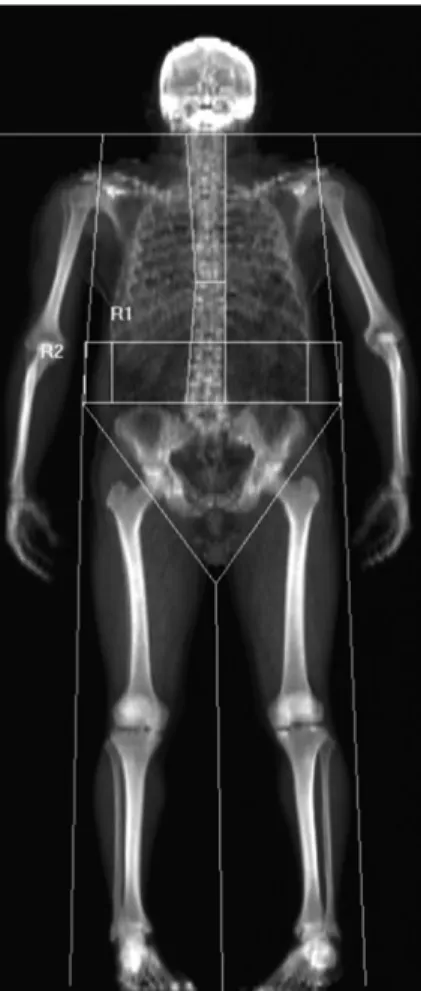 Figure 1 Image of a dual energy X-ray absorptiometry scan showing the abdominal region of interest (R2), defined as the area within the upper edge of the second lumbar vertebra, and the lower edge of the fourth lumbar vertebra and central abdominal region 
