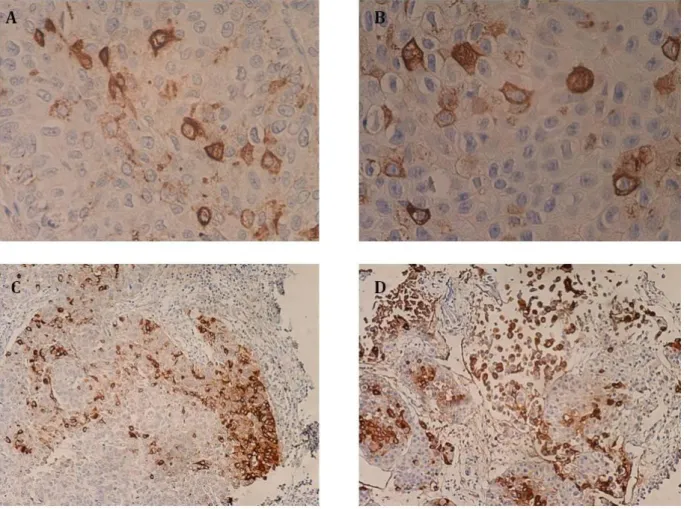 Figure  7  |  Expression  of  STn  in  bladder  tumors.  A)  and  B)  Magnification  showing  undifferentiated tumor cells (high nuclear/cytoplasmatic ratio), with membrane and cytoplasmatic  STn +  staining; C) High-grade papillary tumor showing invasion 