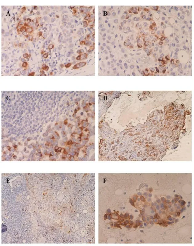 Figure 10 | Expression of STn in lymph node and distant metastasis. A) and B)  Magnification  showing tumor cells with  membrane and cytoplasmatic STn +  staining