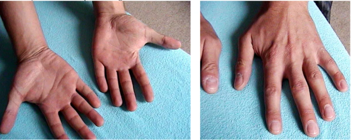 Fig. 5-6. Mãos secas, tanto no dorso, quanto nas palmas. As mãos têm aspecto fibroso. 