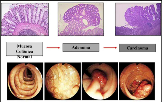 Figura  02:  Sequência  adenoma-carcinoma  em  câncer  colorretal.  A  iniciação  e  progressão  da  tumorogênese de uma mucosa normal até carcinoma e metástase é geralmente associada a características  morfológicas (colonoscopia) e histopatológicas (fotom