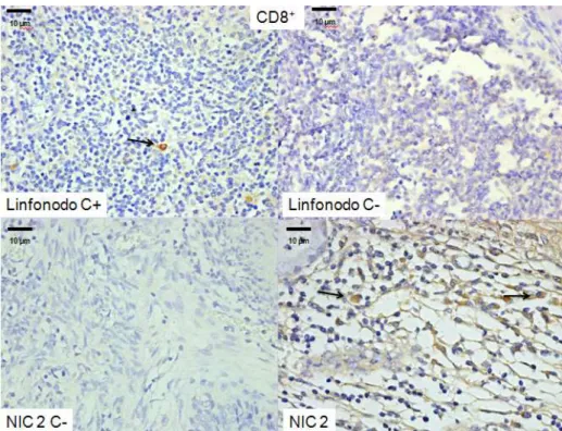Figura  7  Marcação  imunoistoquímica para  o  receptor  CD8 em  amostra  de  linfonodo (controle  positivo  (C+) / negativo (C-) ) e em uma amostra de NIC2