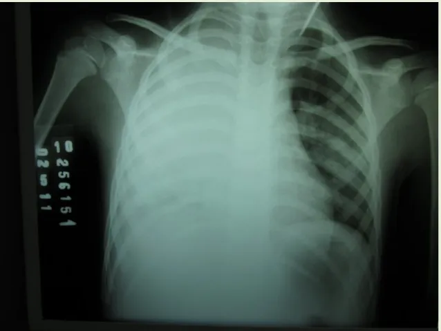 Figura 1. Radiografia do tórax de entrada no Pronto Socorro 02/05/2011. 