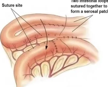 Figure  5.:   Serosal patch  technique.  Serosal  patch  consists  on  suturing  the  antimesenteric  surface  of  a  mobile  intestinal loop over a questionable suture line (Adapted from Radlinsky, 2013)