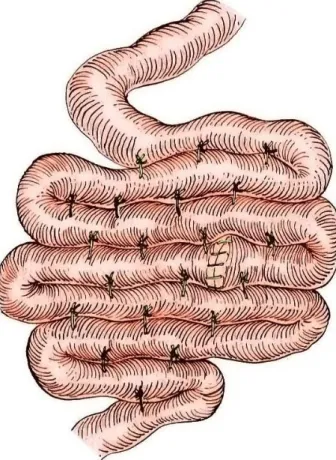 Figure 6.:  Bowel plication. Intestinal loops are tie together to prevent intussusceptions recurrence (Adapted from  Bright, 2006)