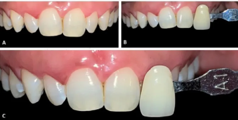 Figure 1. A: Anterior teeth before rehabilitative treatment. B: Selection  of the initial shade A2