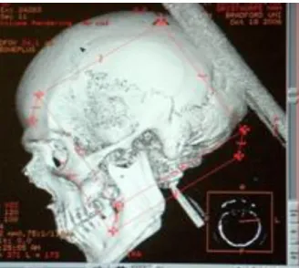 Figure 2. Three-dimensional view of a skull from a CT scan 20