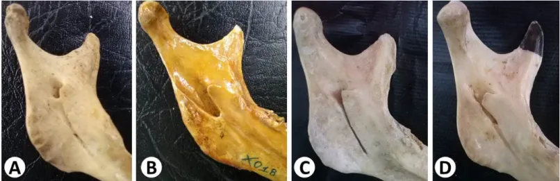 Figure 6. Morphological aspects of the mandibular foramen. In “A” the superior posterior located foramen; location of the posterior inferior  foramen in “B”; and in “C” the triangular shape of the mandible lingula, while in “D” the trapezoidal shape of the