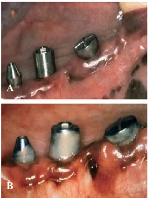 Figura  4  -  Após  a  colocação  do  implante  e  um  meticuloso  controlo  de  placa,  tecidos  mucosos  peri- peri-implantares saudáveis são evidentes em redor dos implantes (a); após 5 meses de acumulação de biofilme,  os  depósitos  de  placa  são  cl