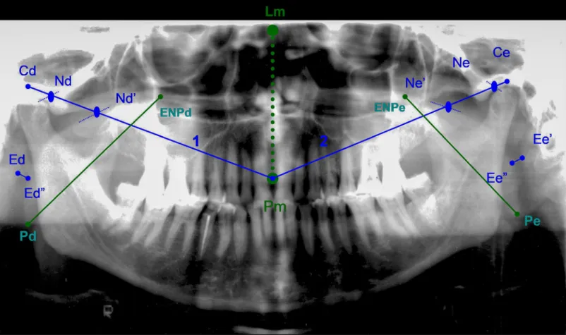 Figure 1. Radiograph tracing with the reference points and the linear measurements