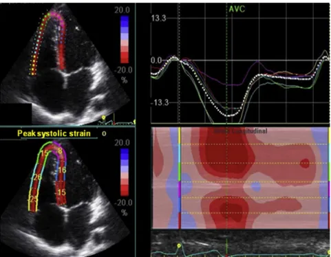 Table 2 Doppler echocardiographic diastolic parameters in patients with SCD compared with controls