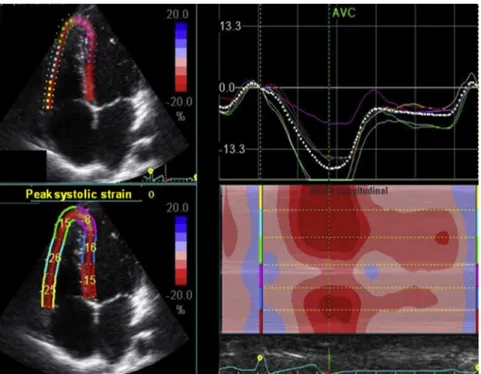 Table 2 Doppler echocardiographic diastolic parameters in patients with SCD compared with controls