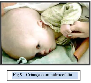 Fig 9 - Criança com hidrocefalia 