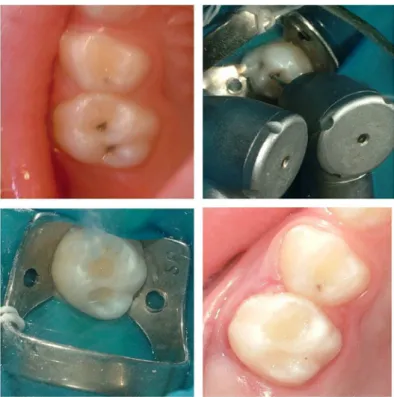 Figure 2. Clinical steps of cavity preparation with high-speed tips: A. 