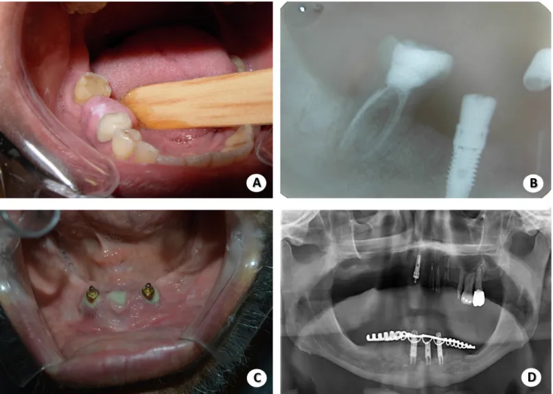 Figure 2. Examples of complications related to the installation of dental implants. “A” is the presence of a nodule located in the peri-implant re- re-gion of element 46, suggestive of reactional lesion; in “B” we have the periapical showing nodule associa
