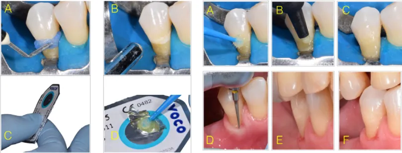 Figure 4. Restorative procedure: A. Adhesive system being applied for  20 s with vigorous agitation on enamel and dentin