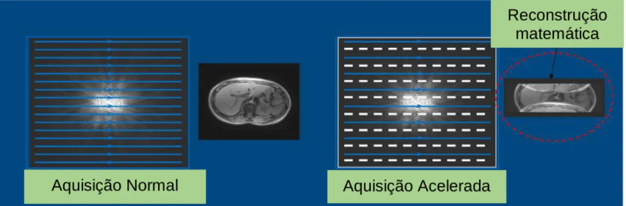 Fig. 14 Scan normal versus Scan com a utilização da técnica imagem paralela  Adaptado de: Siemens 