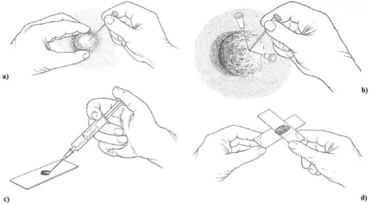 Figura 3: Esquema representativo do método de realização de aspiração com agulha fina: a) fixar o linfonodo/massa  com uma mão; b) inserir e redirecionar a agulha fina no  linfonodo várias vezes; c) encher a seringa de ar e depois  acoplá-la à agulha, expe