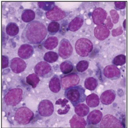 Figura  5:  Imagem  citológica  de  um  aspirado  de  um  linfonodo  de  um  cão  com  linfoma