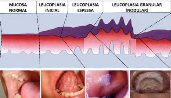 Figura 3. Esquema ilustrativo dos diversos aspectos clínicos da Leucoplasia Oral (homôgenea e  não homôgena) versus sua natureza morfológica