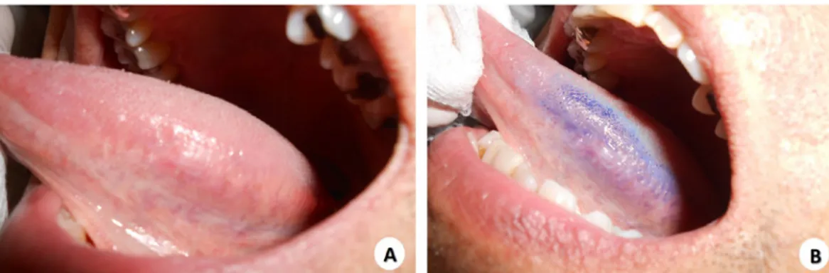 Figura 4.  Aplicação  da  técnica  do  azul  de  toluidina  (Técnica  de  Mashberg).  Em  “A”  identificação  da   lesão branca suspeita de Leucoplasia em borda lateral de lingua e em “B” aplicação do corante com  remoção do seu excesso