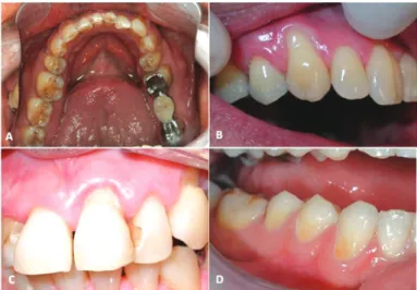 Figura 1. Aspectos clínicos das lesões não cariosas: A – atrição, B –  abrasão, C – abfração, D – erosão