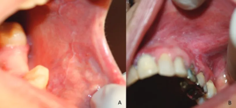Figura 2. Comparação entre lesões de LPO e RLO. A. Lesões estriadas  branca em mucosa jugal esquerda, diagnosticada como LPO; B