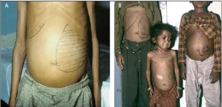 Figura  2.  Leishmaniose  visceral  no  Estado  de  Bihar,  Índia.  (A)  Indíviduo  com  hepatoesplenomegalia  acentuada  e  desnutrição