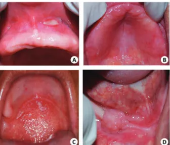 Figure 3. Clinical aspects of lesions caused by the use of re- re-movable prosthesis.A - traumaticulcer; B - Prosthetic  stoma-titis; C - Candidiasis Erythema and Pseudomembranous; D -  Fibrous Hyperplasia Inflammatory