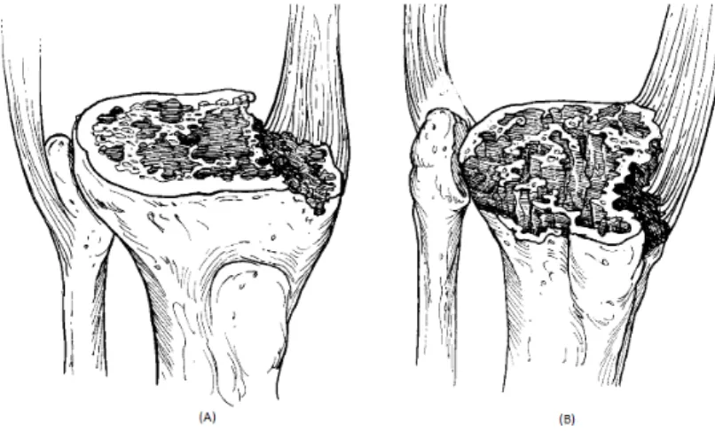 Figure 2.18: Bone Defect Type 2a (A). Bone Defects Type 2b (B). [6]