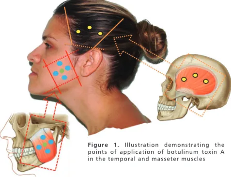 Table 1. Application technique and dilution of Botulinum Toxin Type  A in Patients with Cerebral Palsy with clenching and/or bruxism