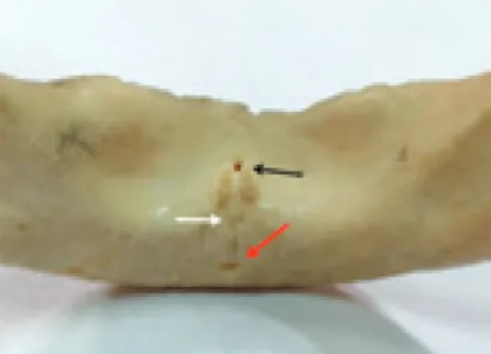 Figura 3. Análise em mandíbula denta- denta-da. Forame lateralmente à linha  media-na mandibular indicado pela seta azul