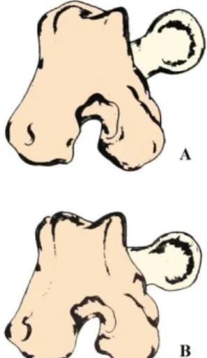 Figura 4. Representação do ângulo de  inclinação do colo femoral normal (B), coxa  vara (C), coxa valga (A)