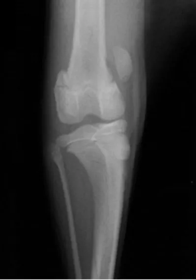 Figura 8. Imagem radiográfica de uma luxação  medial da patela grau IV. Projeção craniocaudal