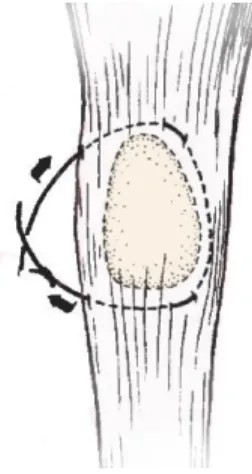 Figura 11. Pormenor da sutura antirrotacional  em volta da patela. Adaptado de Piermattei et  al., 2006
