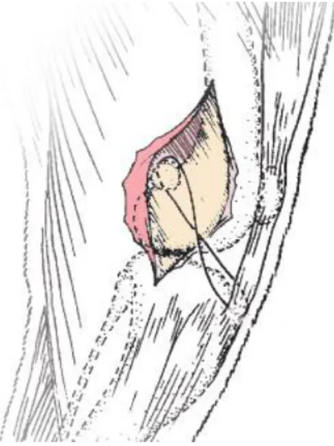 Figura 12. Sutura antirrotacional  fabelotibial. Adaptado de Piermattei et  al., 2006