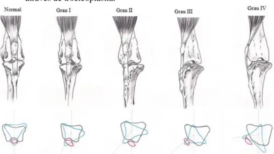 Figura 6:  Deformidades esqueléticas associadas à LP. As imagens em vista cranial mostram como a relação do fémur  distal e tíbia proximal afetam a posição da patela