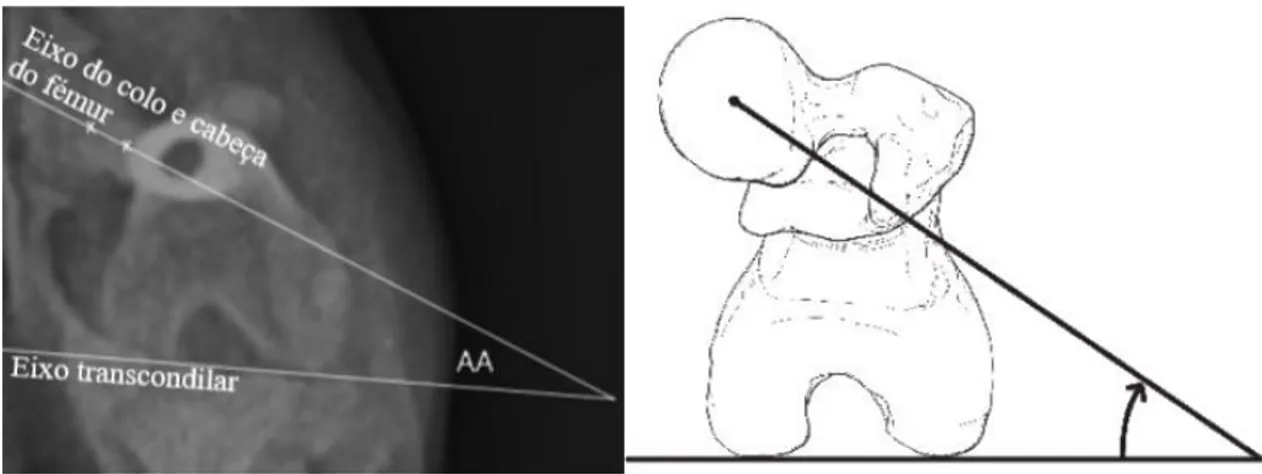 Figura 8:   Imagem da esquerda corresponde a uma radiografia axial do fémur com a identificação dos eixos  (linhas brancas) usados para calcular o AA
