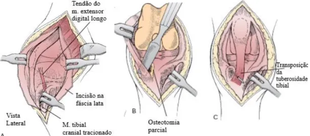 Figura 24:  Ilustração da TTT para correção de LPM. A, Incisão parapatelar lateral na fáscia lata em sentido  distal sobre a TT