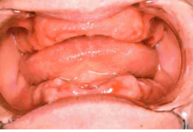 Figura 5. Maxila e mandíbula de um paciente edêntulo (retirado de Mersel, 2017). 
